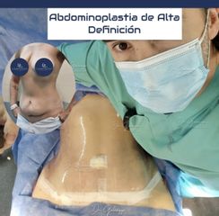Abdominoplastia - Dr. Damián Galeazzo y Equipo