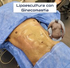 Ginecomastía - Dr. Damián Galeazzo y Equipo