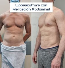 Liposucción - Dr. Damián Galeazzo y Equipo