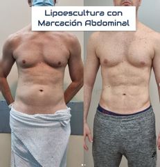 Lipoescultura - Dr. Damián Galeazzo y Equipo