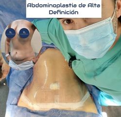 Abdominoplastia - Dr. Damián Galeazzo y Equipo
