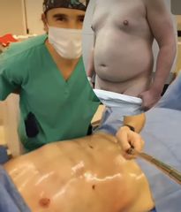 Dr Galeazzo- Lipoescultura Marcación abdomen-
