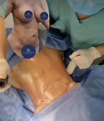 Liposucción - Dr. Damián Galeazzo y Equipo