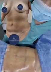 Liposucción - Dr. Damián Galeazzo y Equipo