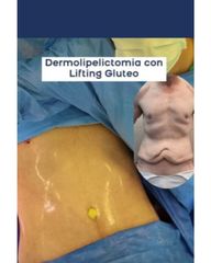 Dermolipectomía - Dr. Damián Galeazzo y Equipo