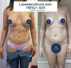 Lipo con RENUVION J PLASMA - Dr. Damián Galeazzo y Equipo