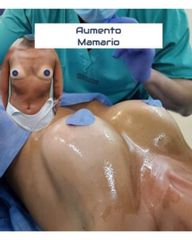 Aumento mamas - Dr. Damián Galeazzo y Equipo