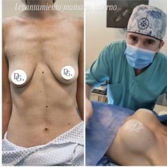 Aumento mamas - Dr. Damián Galeazzo y Equipo