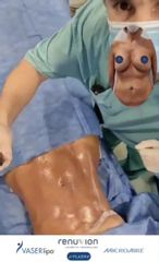 Renuvion+VaserLipo+Microaire = Dr Galeazzo