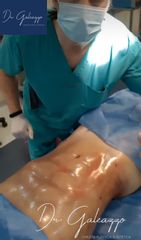 Liposucción con tecnología Innovadora. Dr Galeazzo