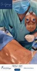 Abdominoplastía Invertida- Dr Galeazzo
