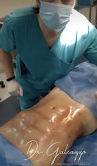 Lipoescultura- Dr Galeazzo