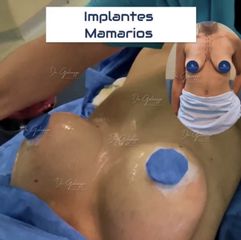 Aumento mamas. Dr Galeazzo