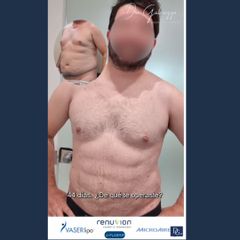 Lipo con RENUVION J PLASMA - Dr. Damián Galeazzo y Equipo