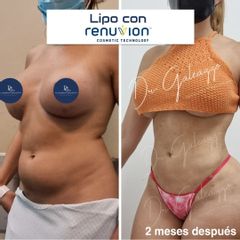 Lipoescultura - Dr. Damián Galeazzo y Equipo