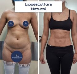 Lipoescultura - Dr. Damián Galeazzo y Equipo