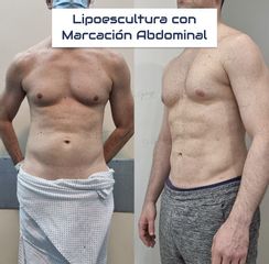 Marcación abdominal lipoescultura HD - Dr. Damián Galeazzo y Equipo
