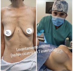 Levantamiento mamario - Dr. Damián Galeazzo y Equipo