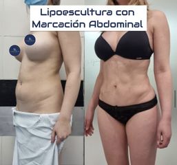 Marcación Abdominal - Dr. Damián Galeazzo y Equipo