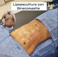 Ginecomastia - Dr. Damián Galeazzo y Equipo