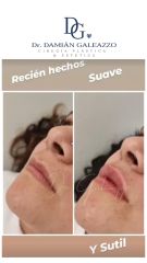 Relleno de labios - Dr. Damián Galeazzo y Equipo