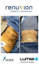 Dermolipectomía - Dr. Damián Galeazzo y Equipo