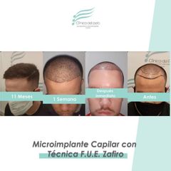 Dr Galeazzo - Implante Capilar