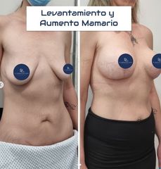 Aumento Mamario-Dr Galeazzo