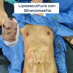 Ginecomastia - Dr. Damián Galeazzo y Equipo