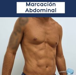 Marcación Abdominal - Dr. Damián Galeazzo y Equipo