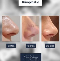 Rinoplastía - Dr. Damián Galeazzo y Equipo