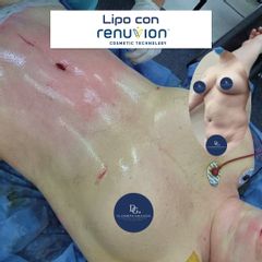 Liposuccion - Dr Galeazzo