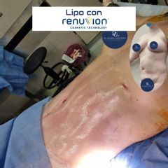Lipoescultura renuvion - DR GALEAZZO-