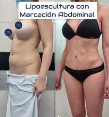 Lipoescultura - Dr. Damián Galeazzo y Equipo