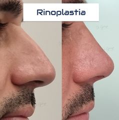 Rinoplastía - Dr. Damián Galeazzo y Equipo