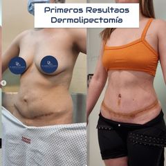 Dermopilectomía - Dr. Damián Galeazzo y Equipo
