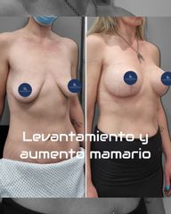 Levantamiento mamario  - Dr. Damián Galeazzo y Equipo