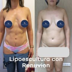 Lipoescultura - Dr. Damián Galeazzo y Equipo