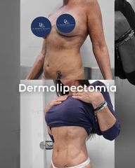 Dermolipectomia - Dr. Damián Galeazzo y Equipo