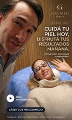 Láser co2 fraccionado - Dr Galeazzo Cirugía Plástica | Galmed