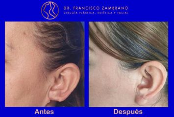 Reconstruccion del lobulo de la oreja