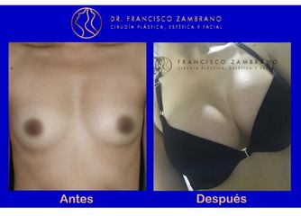 Dr. Francisco Zambrano - MAMOPLASTIA DE AUMENTO 7RESULTADOS