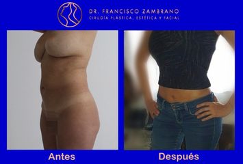 Dr. Francisco Zambrano - Liposuccion, lipectomia , lipoinyeccion glutea