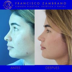 Dr. Francisco Zambrano - Rinoplastia