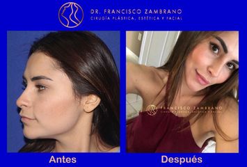 Dr. Francisco Zambrano - Bichectomia + Ácido Hialurónico