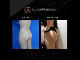 Gluteoplastia - Dr. Francisco Zambrano