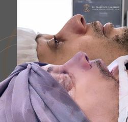 Rinoplastia - Dr. Francisco Zambrano
