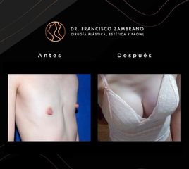 Mamoplastia de aumento - Dr. Francisco Zambrano