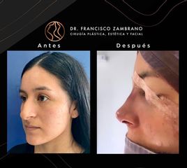 Rinoplastia - Dr. Francisco Zambrano