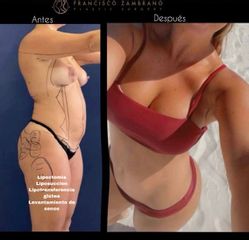 Abdominoplastia - Dr. Francisco Zambrano